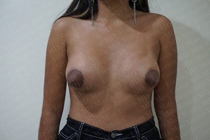 Tuberous Breast Surgery Before & After Patient #2412