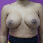 Breast Augmentation Before & After Patient #2509