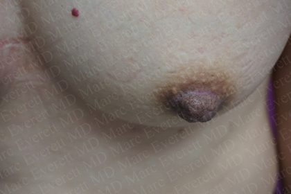 Nipple Procedures Before & After Patient #2419