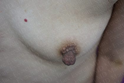 Nipple Procedures Before & After Patient #2419