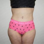 Abdominoplasty Before & After Patient #2339