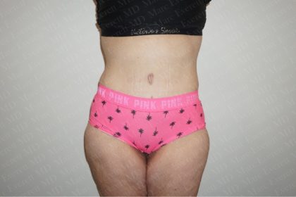 Abdominoplasty Before & After Patient #2339