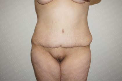 Abdominoplasty Before & After Patient #2339