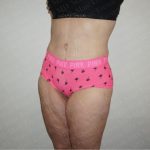 Abdominoplasty Before & After Patient #2339