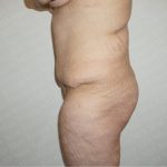 Abdominoplasty Before & After Patient #2339