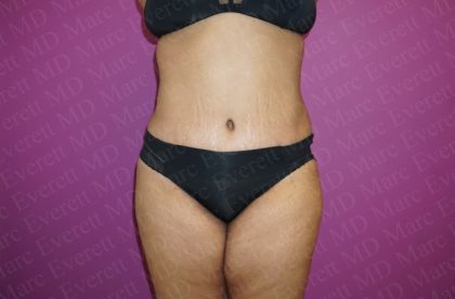 Abdominoplasty Before & After Patient #2069
