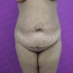 Abdominoplasty Before & After Patient #2069