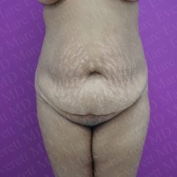 Abdominoplasty Before & After Patient #2069