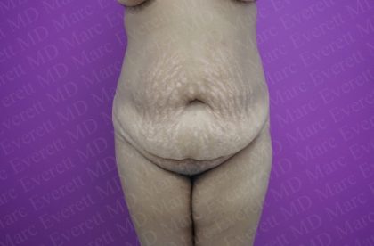 Abdominoplasty Before & After Patient #2069