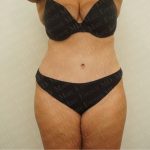 Abdominoplasty Before & After Patient #2438