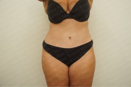 Abdominoplasty Before & After Patient #2438