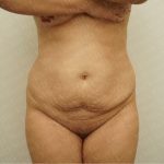 Abdominoplasty Before & After Patient #2438