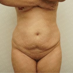 Abdominoplasty Before & After Patient #2438