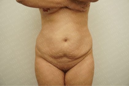 Abdominoplasty Before & After Patient #2438