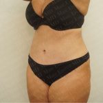 Abdominoplasty Before & After Patient #2438