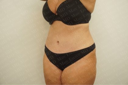 Abdominoplasty Before & After Patient #2438