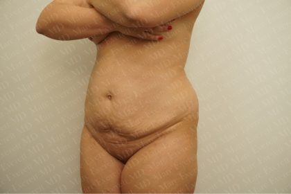 Abdominoplasty Before & After Patient #2438