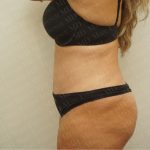 Abdominoplasty Before & After Patient #2438