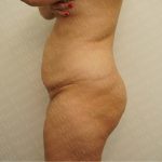 Abdominoplasty Before & After Patient #2438