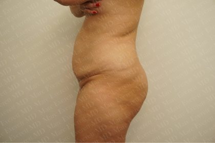 Abdominoplasty Before & After Patient #2438