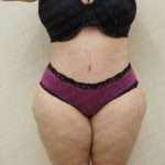 Abdominoplasty Before & After Patient #2103