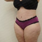 Abdominoplasty Before & After Patient #2103