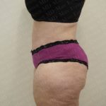 Abdominoplasty Before & After Patient #2103