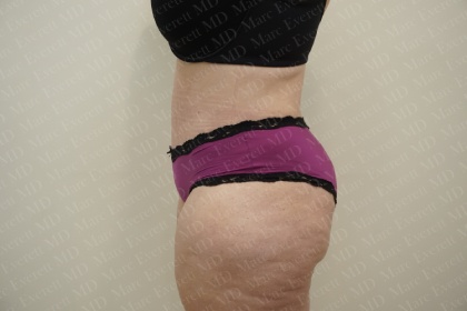 Abdominoplasty Before & After Patient #2103