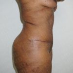 Abdominoplasty Before & After Patient #2094
