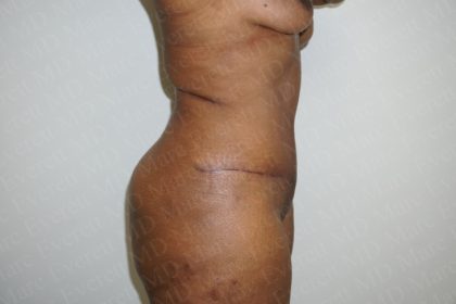 Abdominoplasty Before & After Patient #2094
