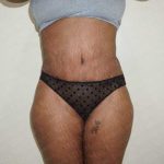 Abdominoplasty Before & After Patient #2116