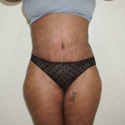 Abdominoplasty Before & After Patient #2116