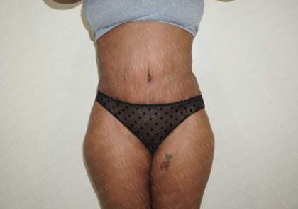 Abdominoplasty Before & After Patient #2116