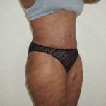 Abdominoplasty Before & After Patient #2116