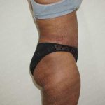 Abdominoplasty Before & After Patient #2116