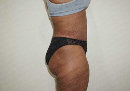 Abdominoplasty Before & After Patient #2116