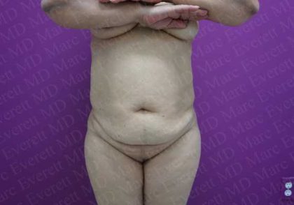 Abdominoplasty Before & After Patient #2114