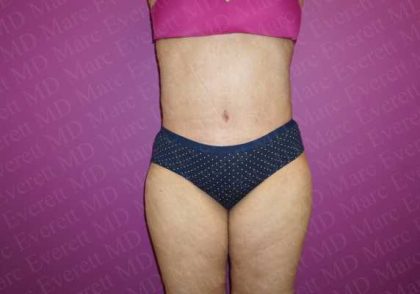 Abdominoplasty Before & After Patient #2114