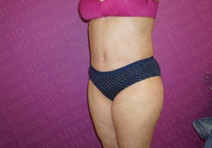 Abdominoplasty Before & After Patient #2114