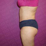 Abdominoplasty Before & After Patient #2114