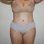 Abdominoplasty Before & After Patient #2113
