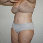 Abdominoplasty Before & After Patient #2113