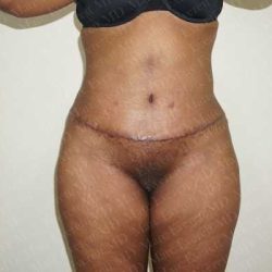 Abdominoplasty Before & After Patient #2112