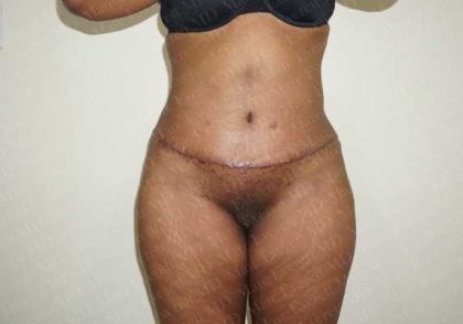 Abdominoplasty Before & After Patient #2112
