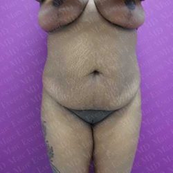 Abdominoplasty Before & After Patient #2109