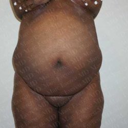 Abdominoplasty Before & After Patient #2108