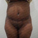 Abdominoplasty Before & After Patient #2108