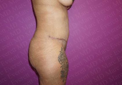 Abdominoplasty Before & After Patient #2107