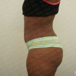 Abdominoplasty Before & After Patient #2102