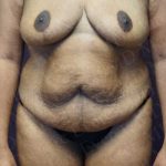 Abdominoplasty Before & After Patient #2106